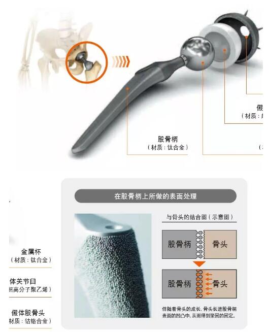 人工骨關節(jié)的結構 人工骨關節(jié)的結構